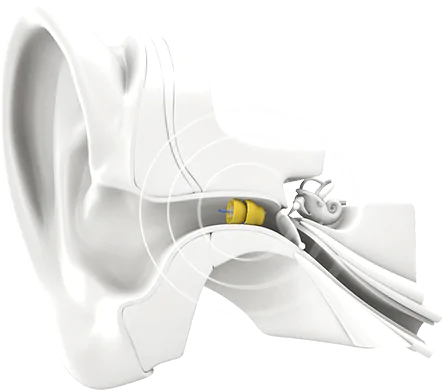 Phonak Lyric